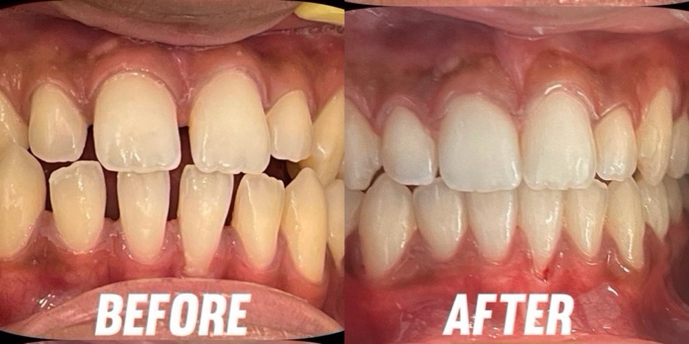 Best Invisible Teeth Aligners in Kochi